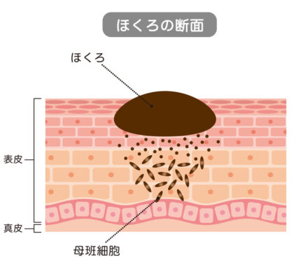 ほくろってそもそも何？