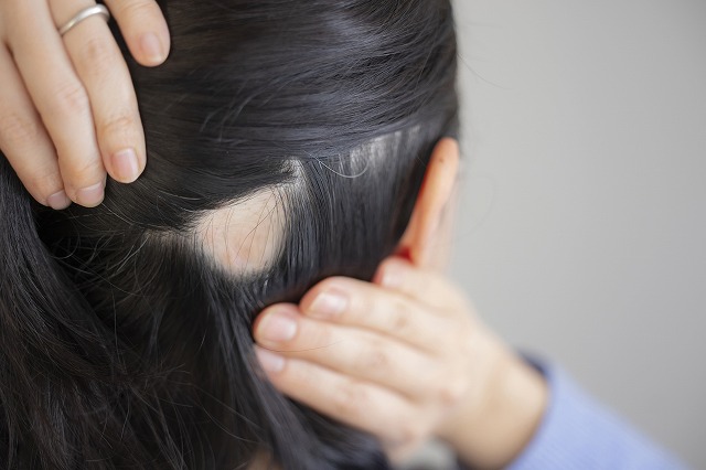 円形脱毛症とは